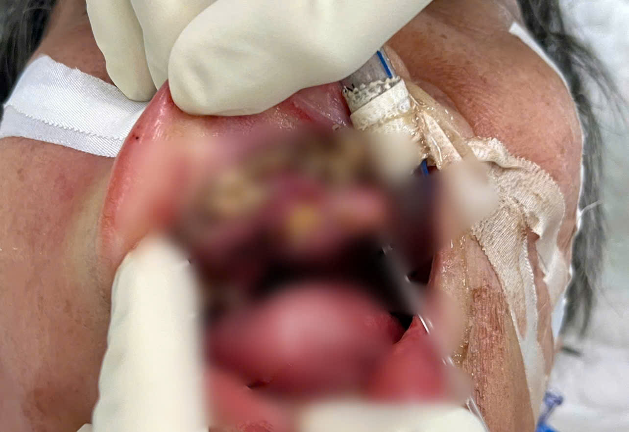 Hơn 100 con giòi “làm tổ” trong miệng cụ bà 69 tuổi